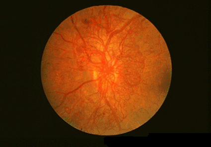 Image: Ophthalmoscope view of the retina of the eye in a diabetic patient showing retinopathy (Photo courtesy of Paul Parker / SPL).